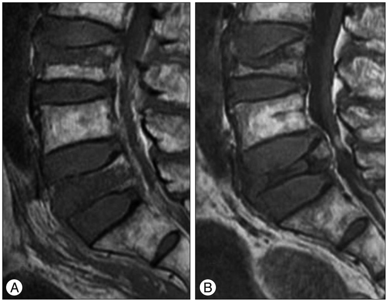 Differentiation of acute and chronic vertebral compression